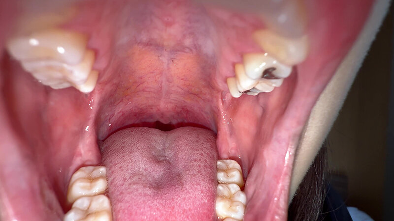 「【湊波流】素人お姉さんをナンパ！舌ブラシで汚舌苔採取する個人撮影動画」のサンプル画像7枚目